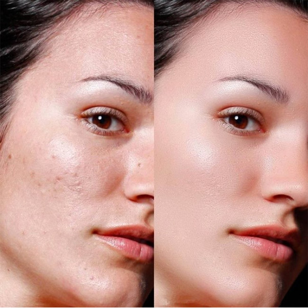  Cách chăm sóc da sau mụn không để lại sẹo hay vết thâm